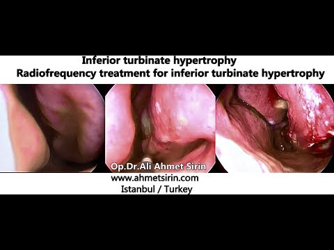 Burun Hastalıkları & Cerrahiler