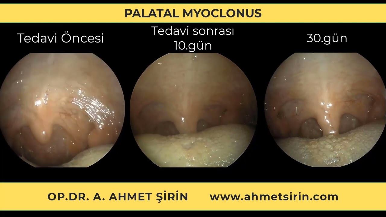 Palatal Myoklonus