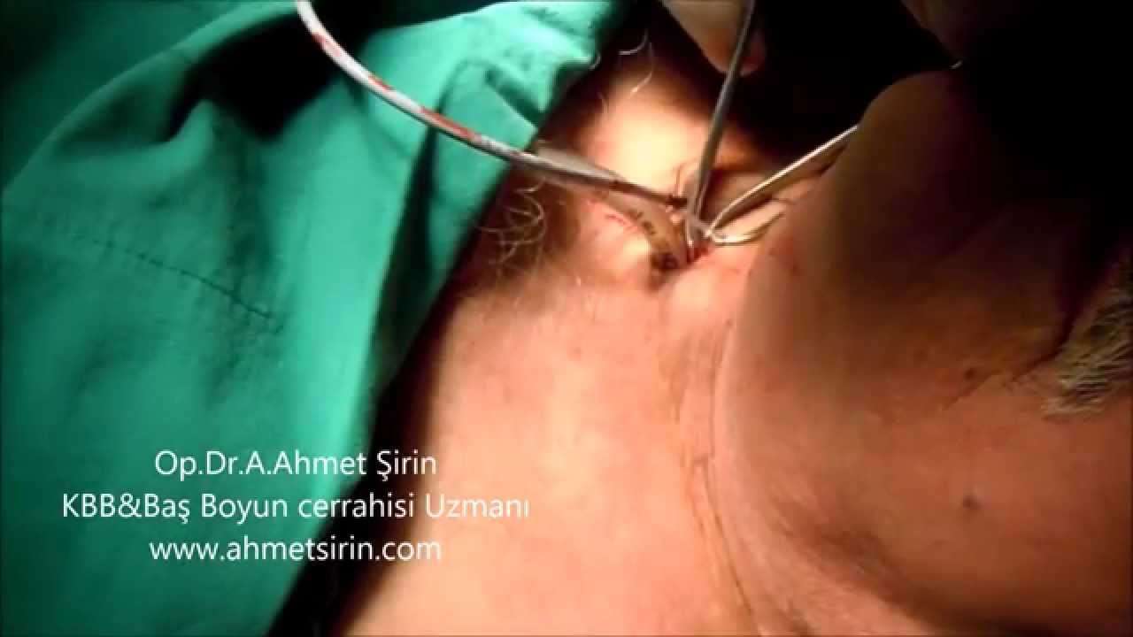 ses protezi,provox,ses,konuşma,konuşma protezi,Larynx (Anatomical Structure),Speech (Quotation Subject),voice prothesis,Cancer Of The Larynx (Disease Or Medical Condition),gırtlak kanseri,gırtlak kanseri sonrası konuşma