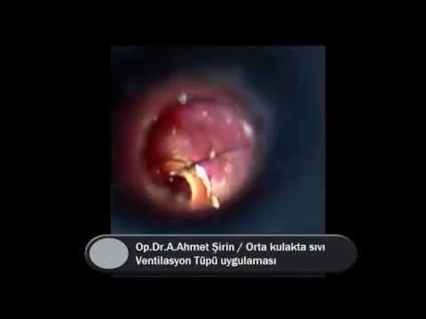 kulak tüpü,ventilasyon tüpü,kulakta sıvı,orta kulakta sıvı,seröz otit,efüzyonlu otit,orta kulak iltihabı