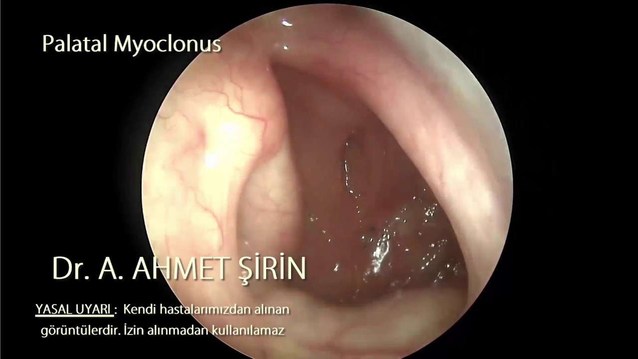 Palatal tremor,Palatal miyoklonusta,Palatal miyoclonusta,objejektif tinnitus,tinnitus,tinnitus treatment,tinnitus tedavisi,tinnitus nedeni,tinnitus yapan nedenler,tuboplasti,östachi kanalı,östachi disfonksiyonu,objective tinnitus,patulous eustachian tu