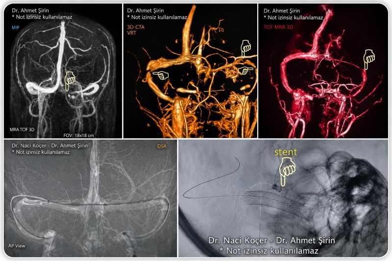 damarsal-tinnitus-konusunda-bilimsel-calismalar