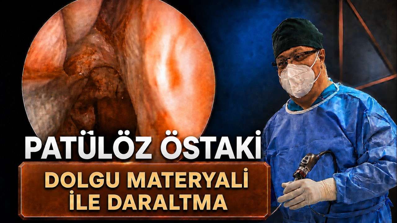 patülöz östaki,patüloz östaki,patulous eustachian tube,östaki tüpü,açık östaki tüpü,östaki tüpü açıklığı,dolgu materyali ile daraltma,östaki tüpü daraltma,endoskopik östaki işlemi,otofoni,kendi sesini kulağında duyma,nefes sesi