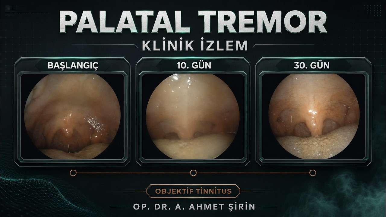 objektif tinnitus,palatal tremor,palatal miyoklonus,palatal myoclonus,objektif kulak çınlaması,damak seğirmesi,damakta kasılma,damakta istemsiz hareket,kulakta tıklama sesi,kulakta tıkırtı,boğazda tıklama sesi,kas kaynaklı tinnitus,miyojenik t