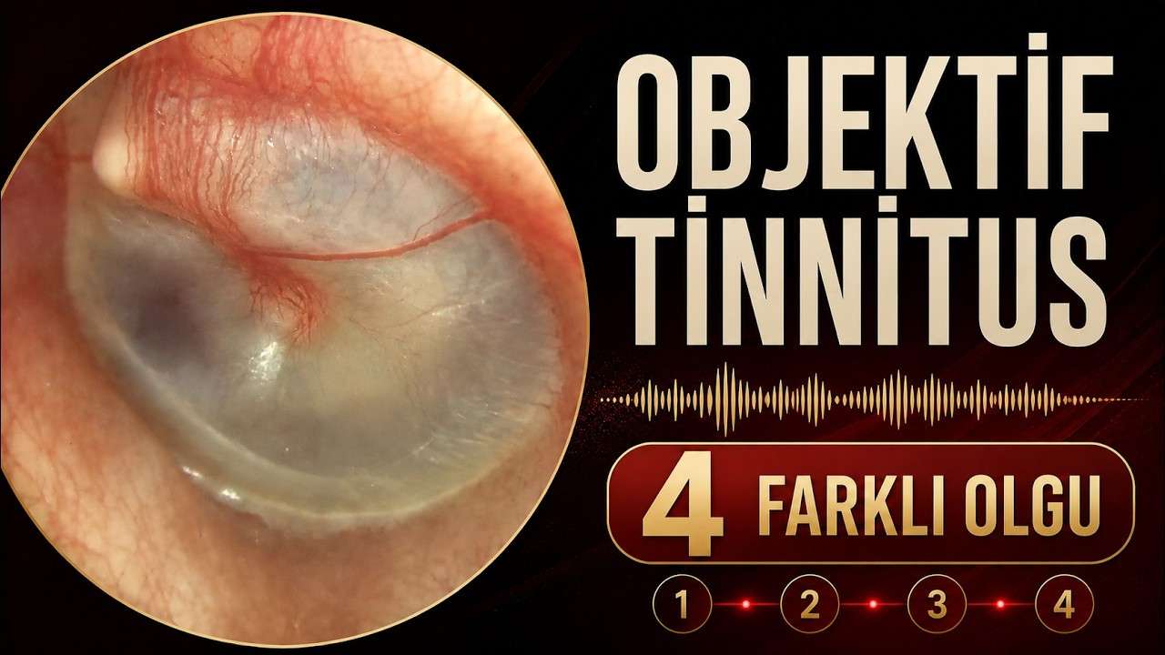 objektif tinnitus,objektif kulak çınlaması,objektif tinnitus nedenleri,kulakta tık tık sesi,kulakta mekanik ses,ritmik kulak sesi,palatal miyoklonus,palatal tremor,orta kulak miyoklonusu,tensor timpani,stapedius kası,patüloz östaki tüpü,patulous